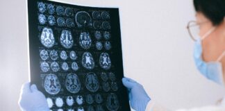 alzheimer università trieste